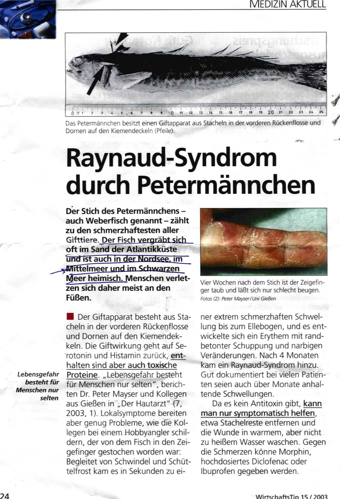 Raynaud-Syndrom